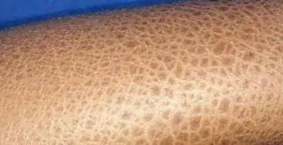 你了解鱼鳞病吗