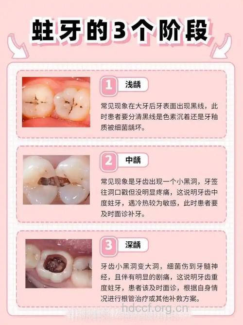蛀牙是怎样得的?