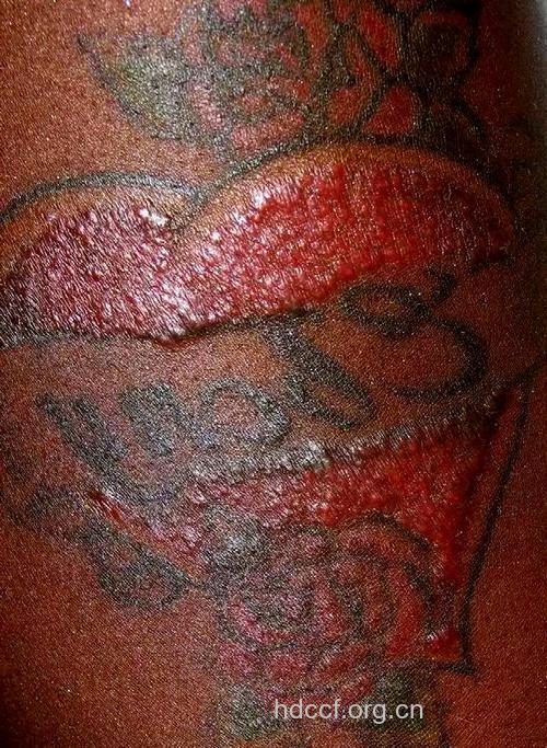 纹身是感染艾滋病的高危行为