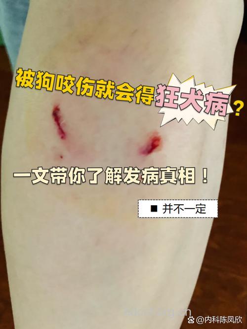 被狗咬会感染艾滋病吗
