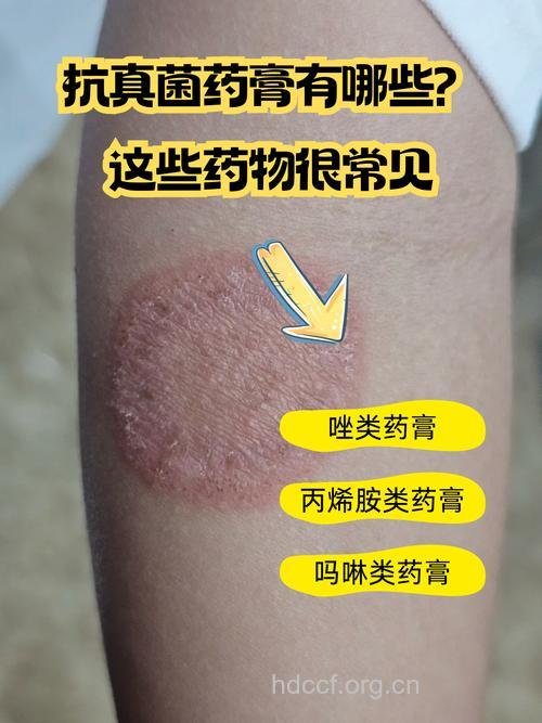 真菌性皮肤病不可随便用药