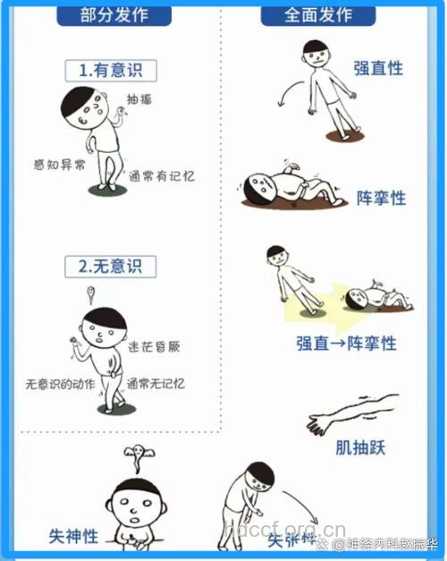 癫痫分型及各型的临床症状？