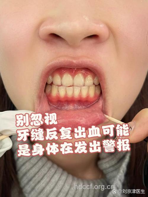 牙龈出血 牙周炎典型的六大症状
