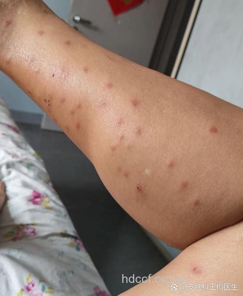 被虫子咬了会感染艾滋病吗