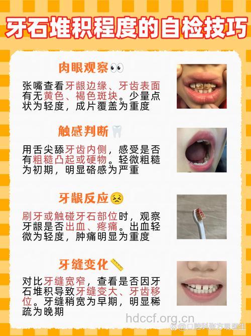 7个方法自测是否患上牙周炎