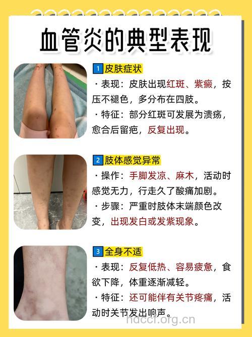 变应性皮肤血管炎诊断以及治疗