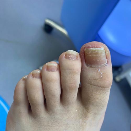 穿尖头小鞋易惹上灰指甲