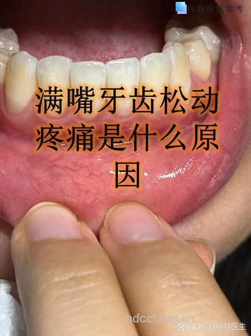 牙齿松动竟会是牙周炎的症状