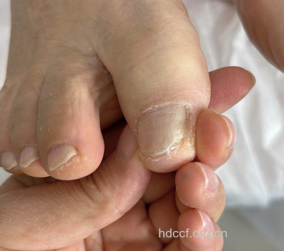 女性常见的几种甲沟炎临床表现