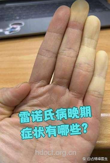 雷诺氏病晚期有什么症状