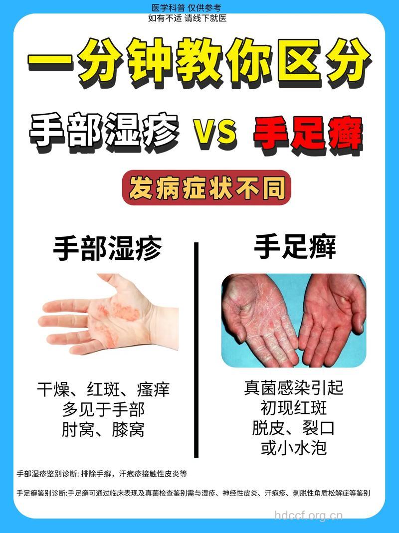 手部湿疹与手癣如何区别治疗