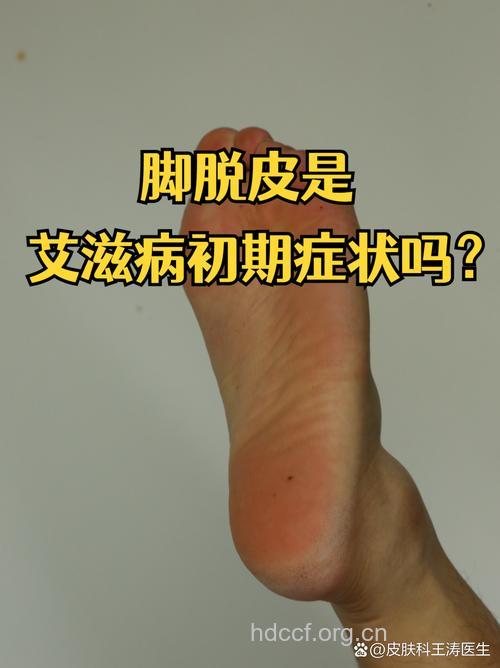 脚气是艾滋病感染的初期症状吗