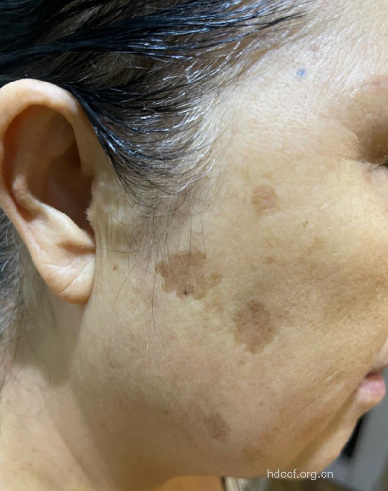 惊悚!长时间面对电脑会长老年斑