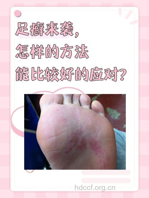脚气患者不治疗当心撞“红线”