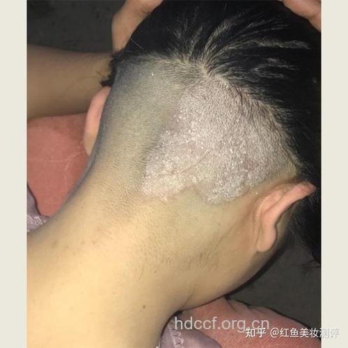 学会看你的头发晒伤没