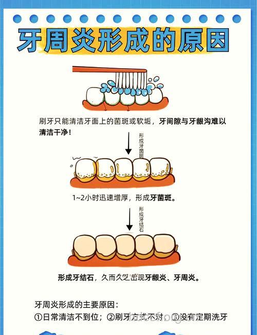 牙周炎的几个预防方法