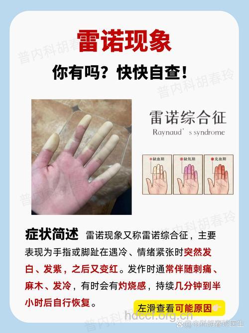 雷诺病的检查项目有哪些