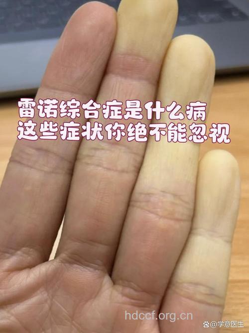 什么是雷诺氏病