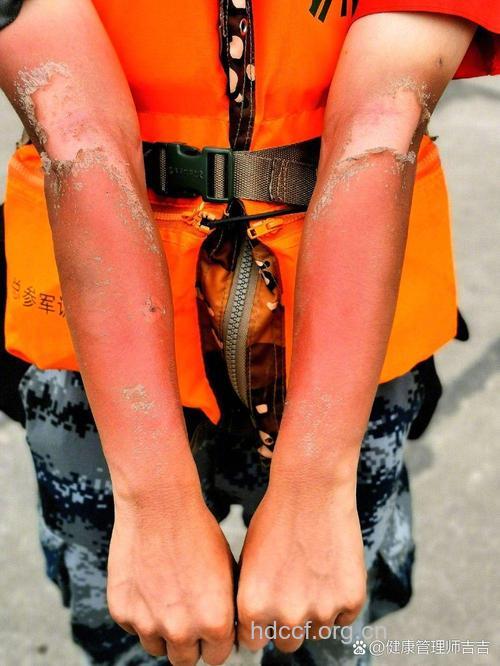 使用果酸容易扩大晒伤机会