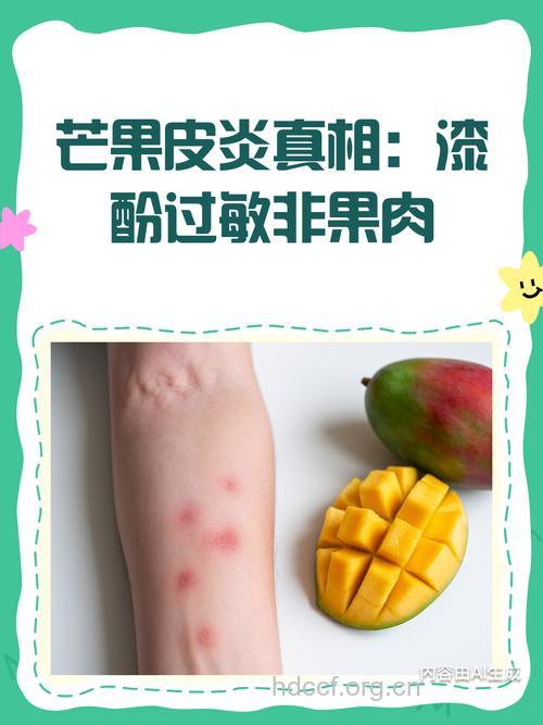 食用鲜芒果小心日光性皮炎
