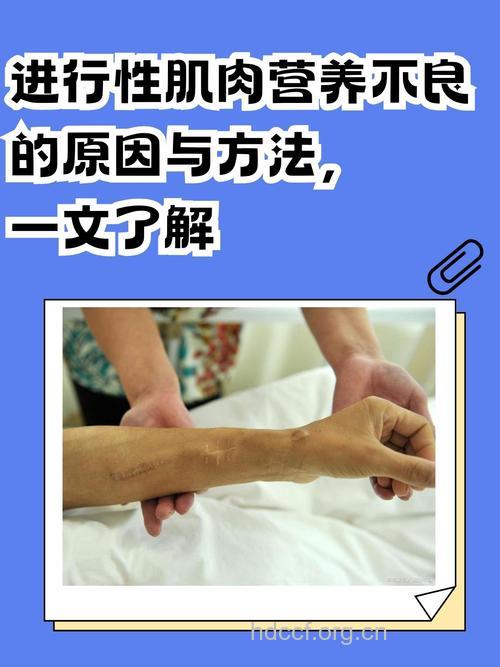 进行性肌营养不良治疗原则及方法