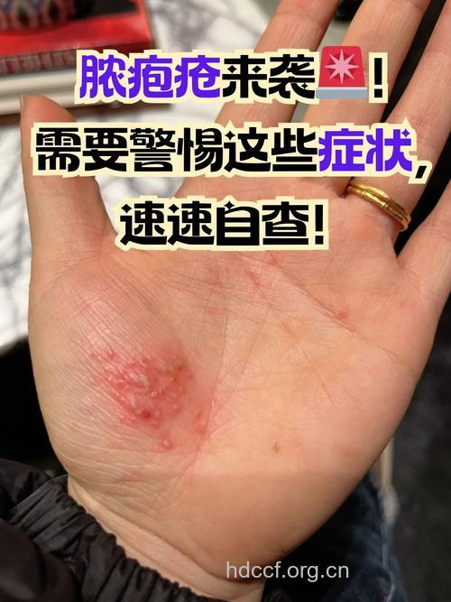 患上脓疱疮 警惕急性肾炎