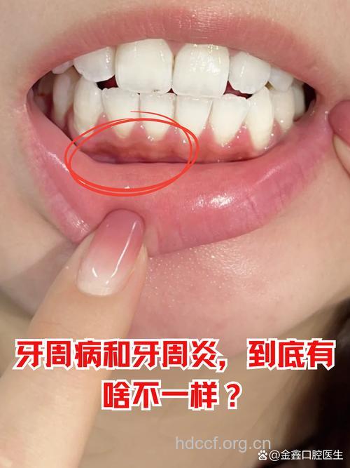 牙周炎的症状与表现