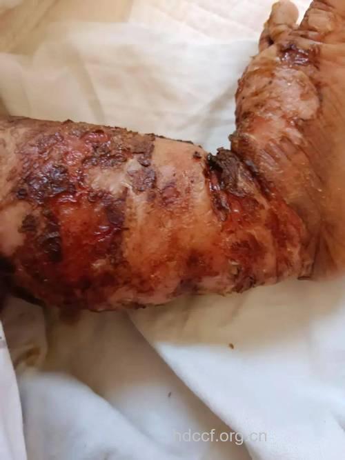 患有鱼鳞病，应正确就医