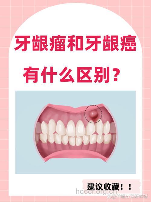 牙龈癌早期症状与牙周炎相似