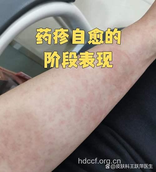 服药后身体长时间现红斑应疑为药疹