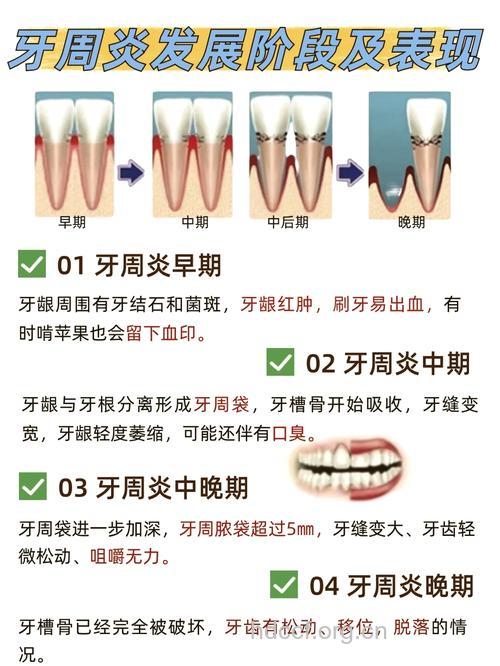 防治牙周炎的5个关键点
