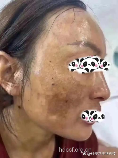 化妆品使用不慎致面部皮肤出新斑