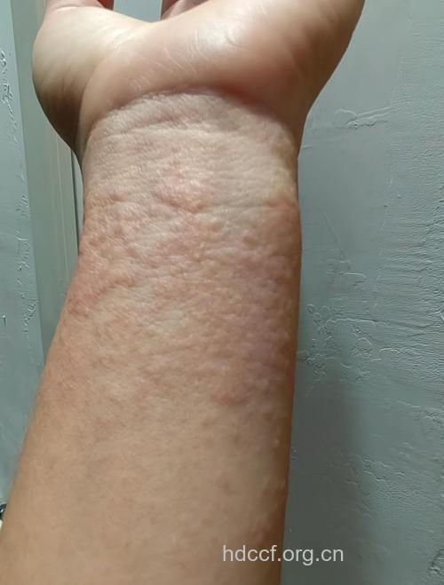 进球功臣突然离场 原为皮肤油漆过敏