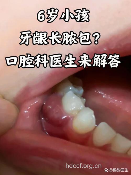 牙龈炎的早期症状有哪些