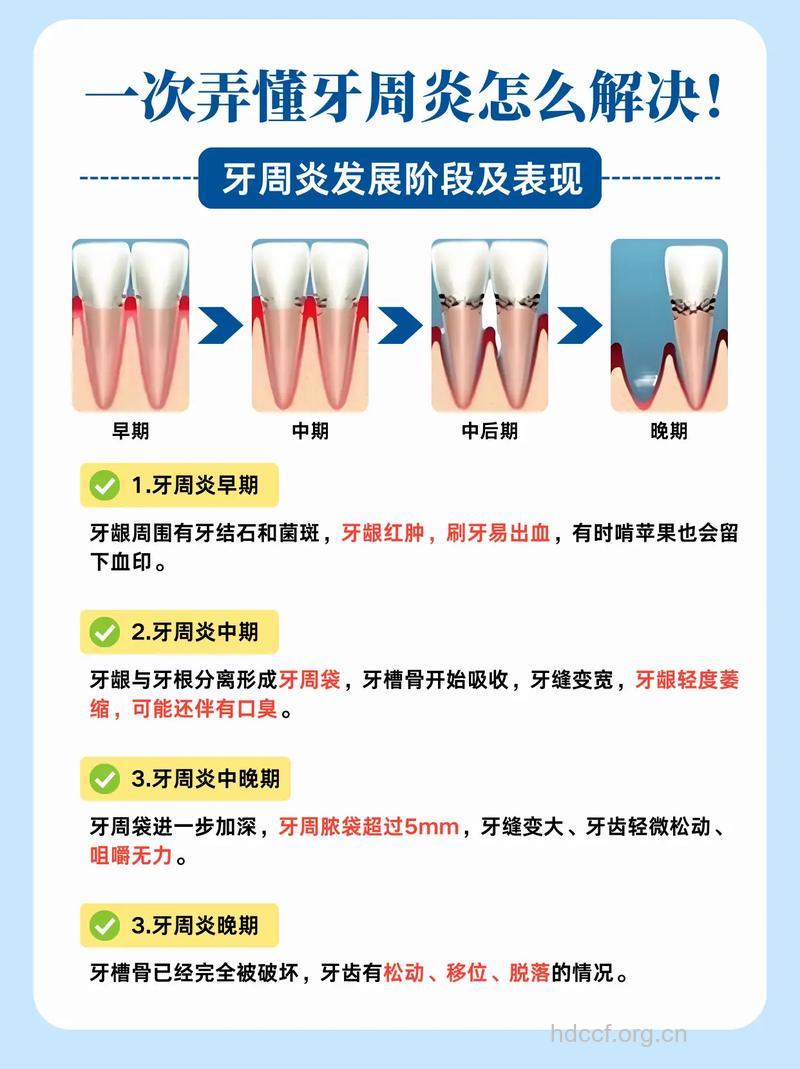 牙周炎症状及治疗处理方法