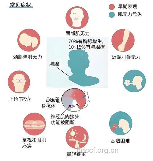 重症肌无力有哪些常见症状