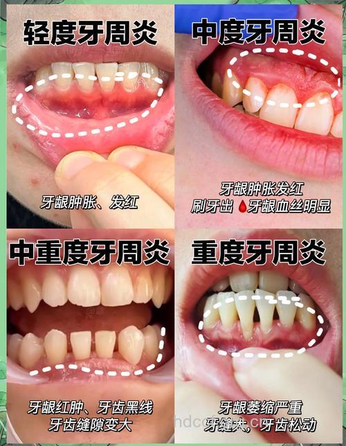 牙周炎的几种症状表现