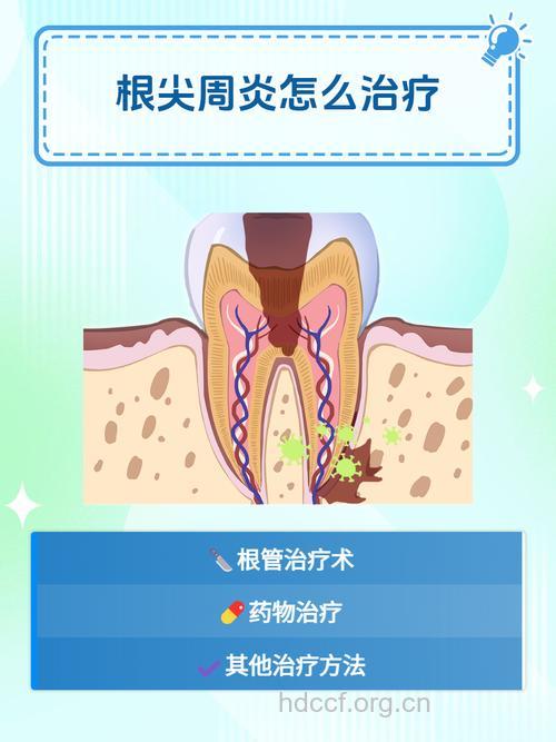 芦荟治疗牙根尖周炎