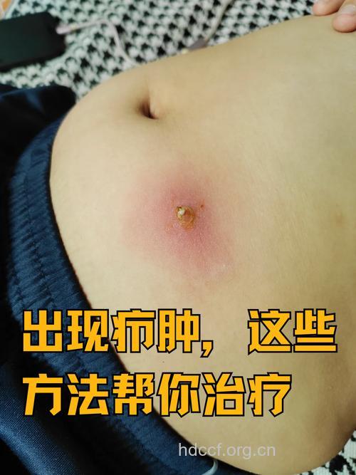 身上长脓包疮能洗澡吗？