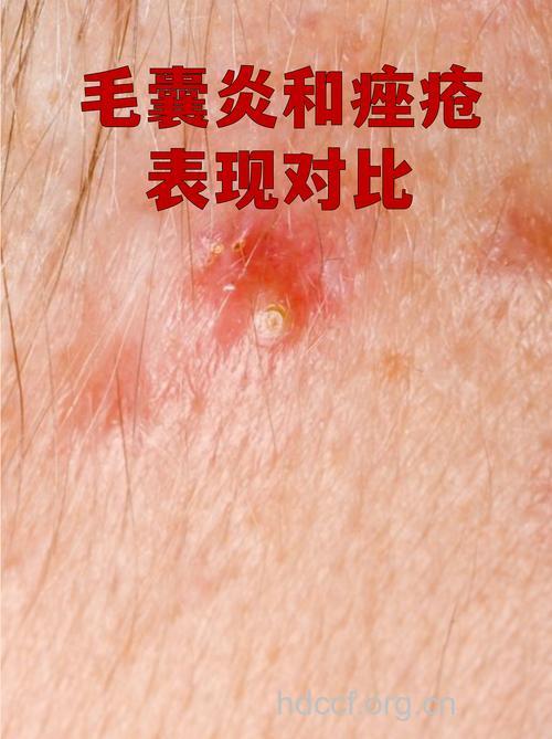 脓疱疮和毛囊炎