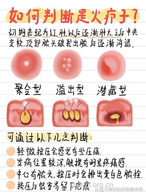 脓包疮的详解