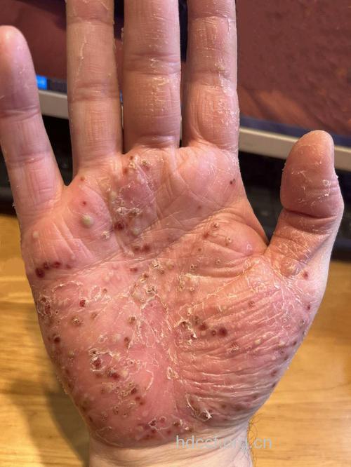 脓疱疮的症状