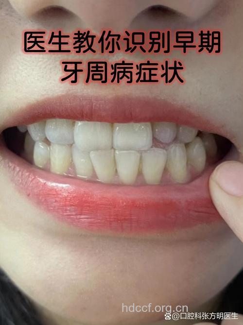 牙周炎有什么明显的症状
