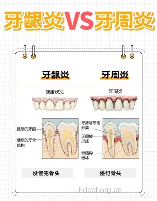 牙周炎和蛀牙有什么关系