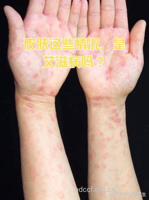 艾滋病发作后的三大反应