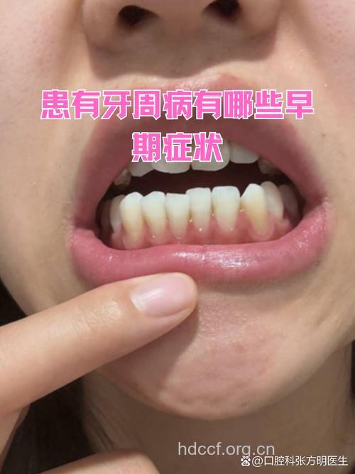 个性急躁的人容易患牙周病