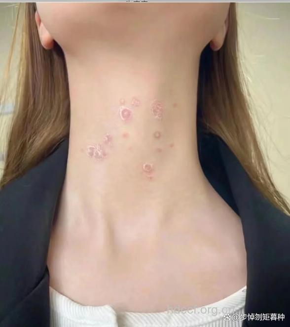 没有了牛皮癣终于可以穿裙子了