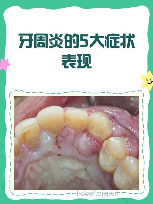 青春前期牙周炎