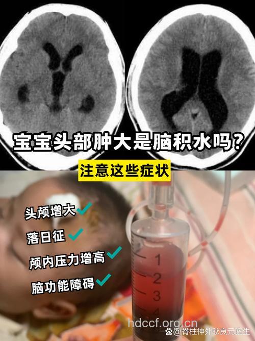 脑积水的临床表现