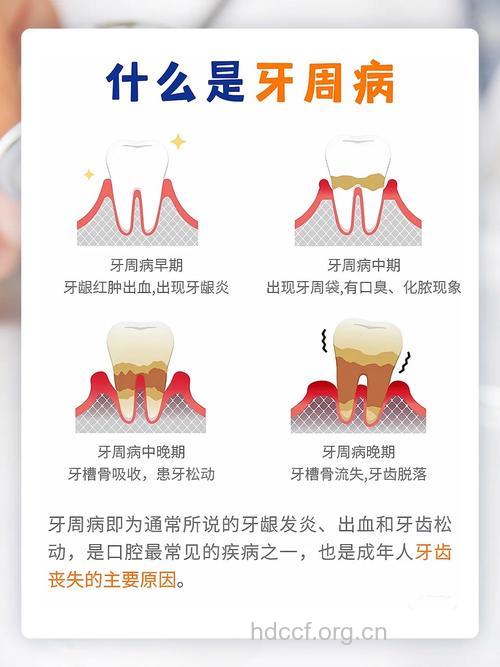 容易得牙周病的三类人群